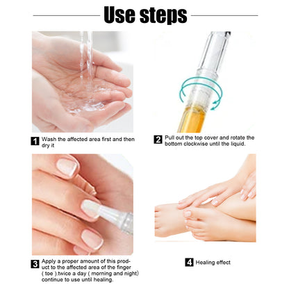 South Moon Exstroyeza Pen, Hand And Foot Gray Nail Repair Gray Nail Solution Thickening Nutritional Repair Solution