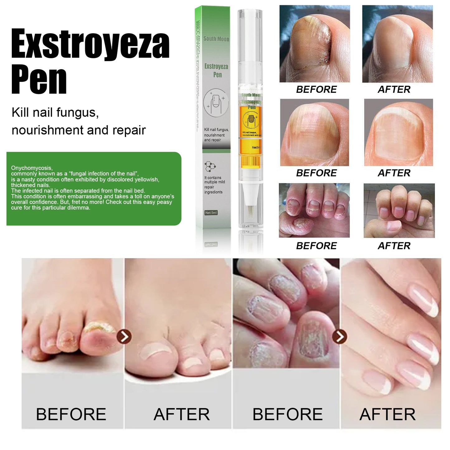 South Moon Exstroyeza Pen, Hand And Foot Gray Nail Repair Gray Nail Solution Thickening Nutritional Repair Solution